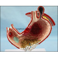 Human Stomach with Ulcers Anatomical Model
